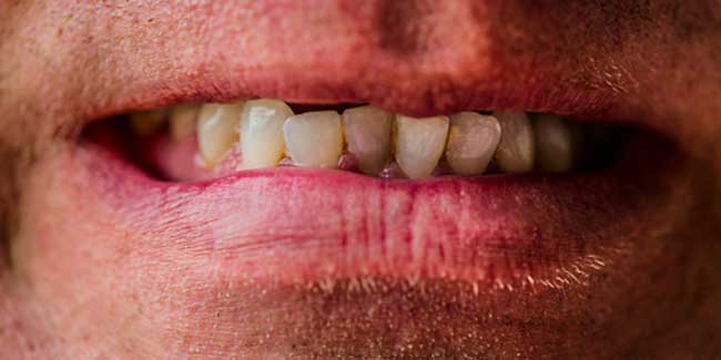 teeth stains tobacco remove